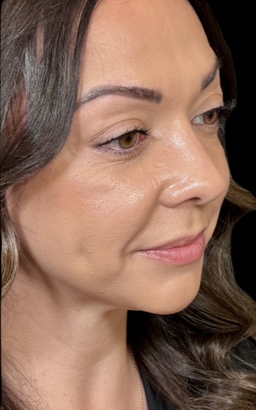 After rhinoplasty angled view showing a refined bridge, straighter nose, and subtle tip definition that complements the face