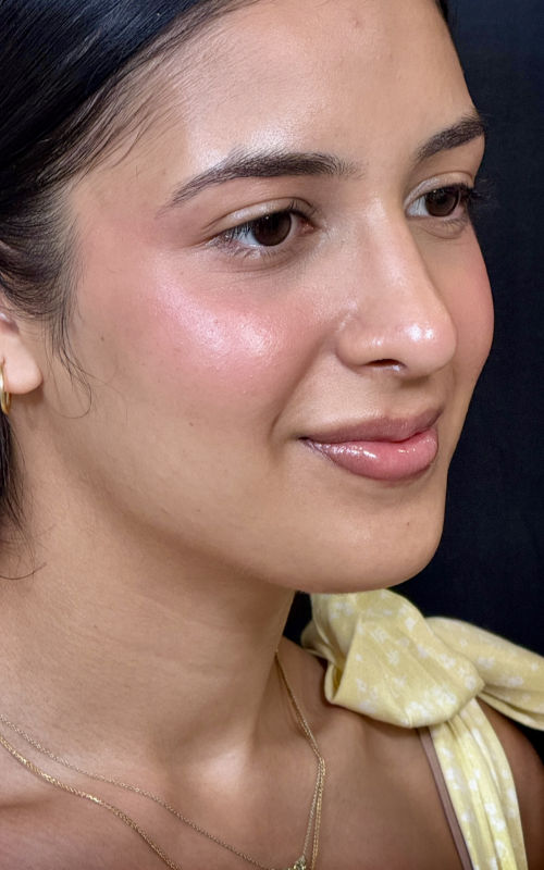 Four months after septorhinoplasty angled view showing improved facial balance with a refined bridge and lifted tip
