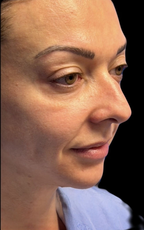 Before rhinoplasty angled view showing a prominent bridge and rounded nasal tip.