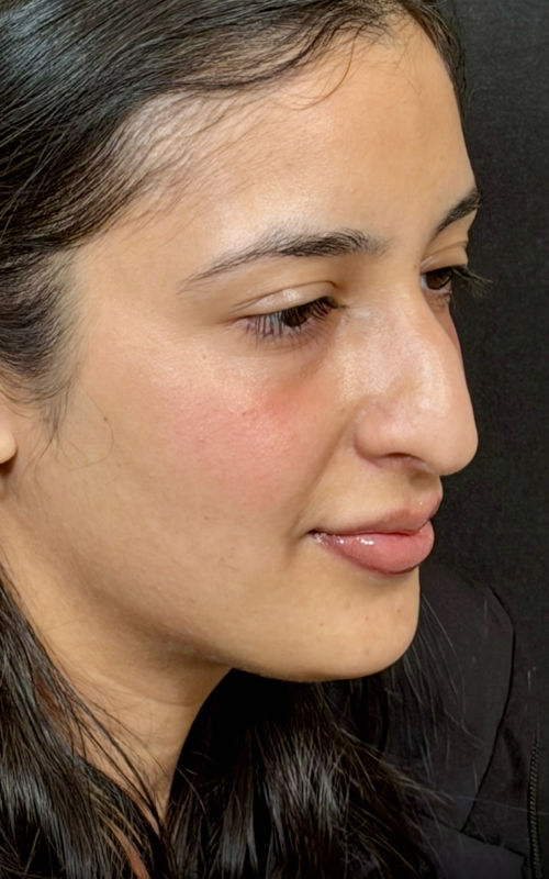 Before rhinoplasty angled view highlighting the bridge hump and tip position.