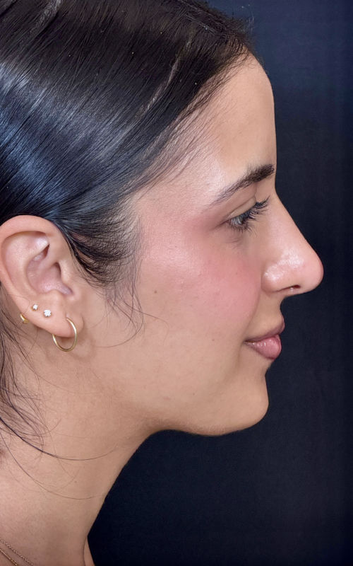 Four months after septorhinoplasty showing a smoother bridge contour and refined nasal profile.