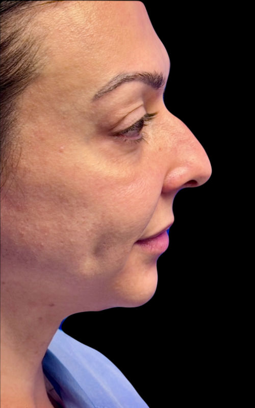 Before rhinoplasty left profile showing a prominent bridge hump and mild tip fullness.