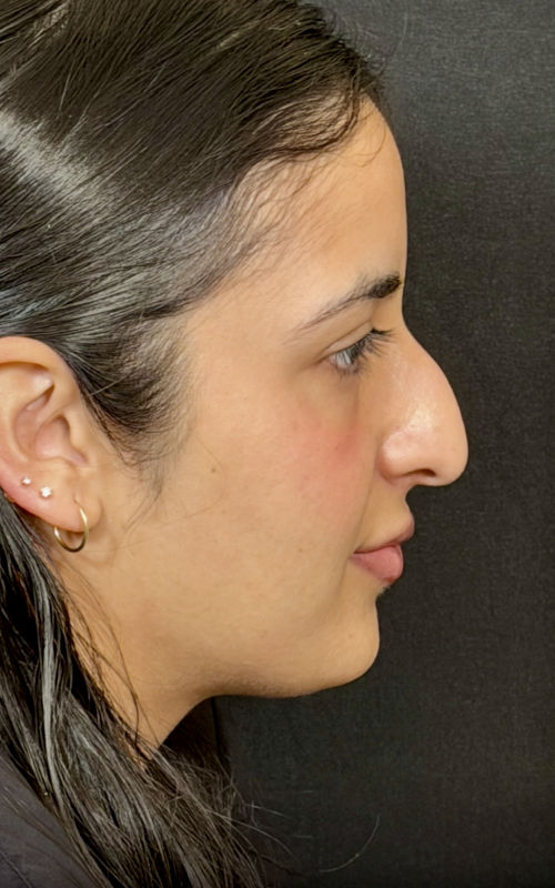 Before rhinoplasty showing a prominent bridge hump and downward-projecting nasal tip.