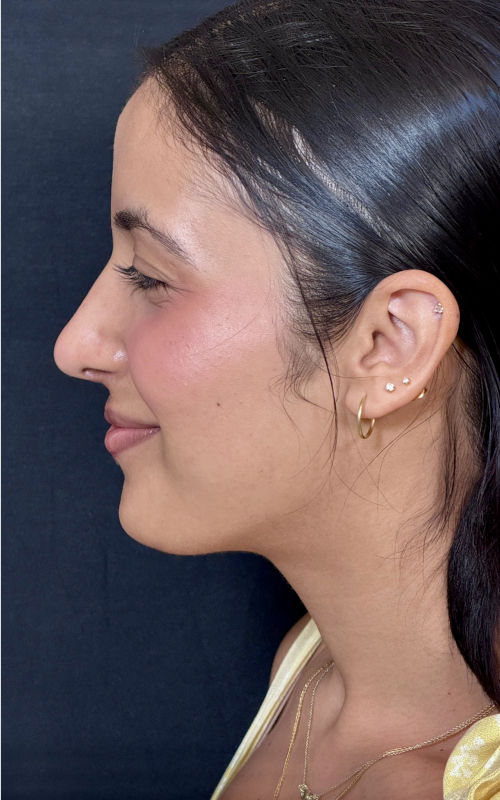Four months after septorhinoplasty showing a straighter nasal bridge, reduced hump, and a naturally lifted tip.