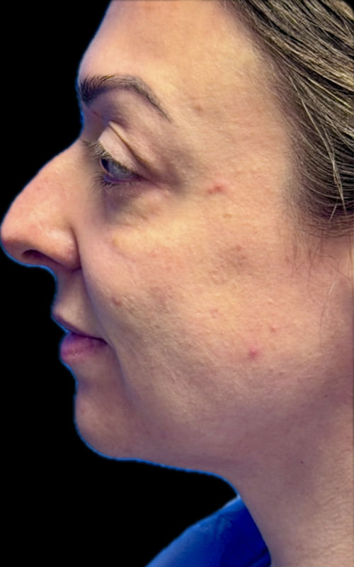 Before rhinoplasty showing a prominent dorsal hump, slight nasal deviation, and a fuller nasal tip from the right profile.