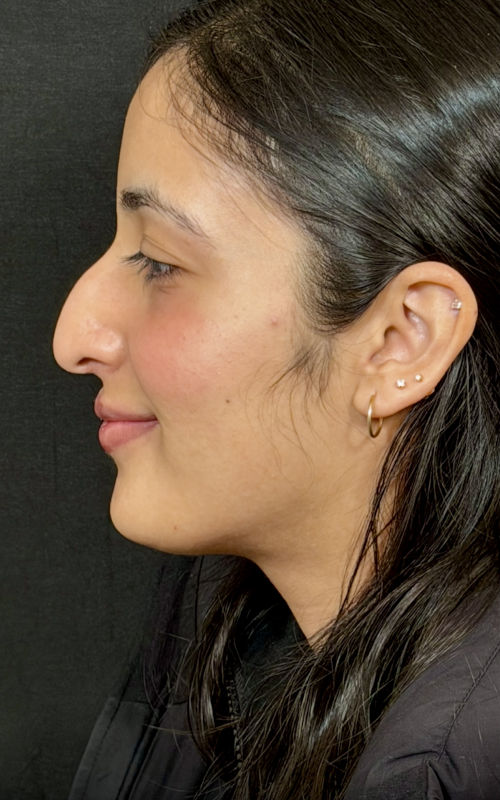 Before rhinoplasty showing a dorsal hump, slight nasal deviation, and a drooping nasal tip from the side profile.