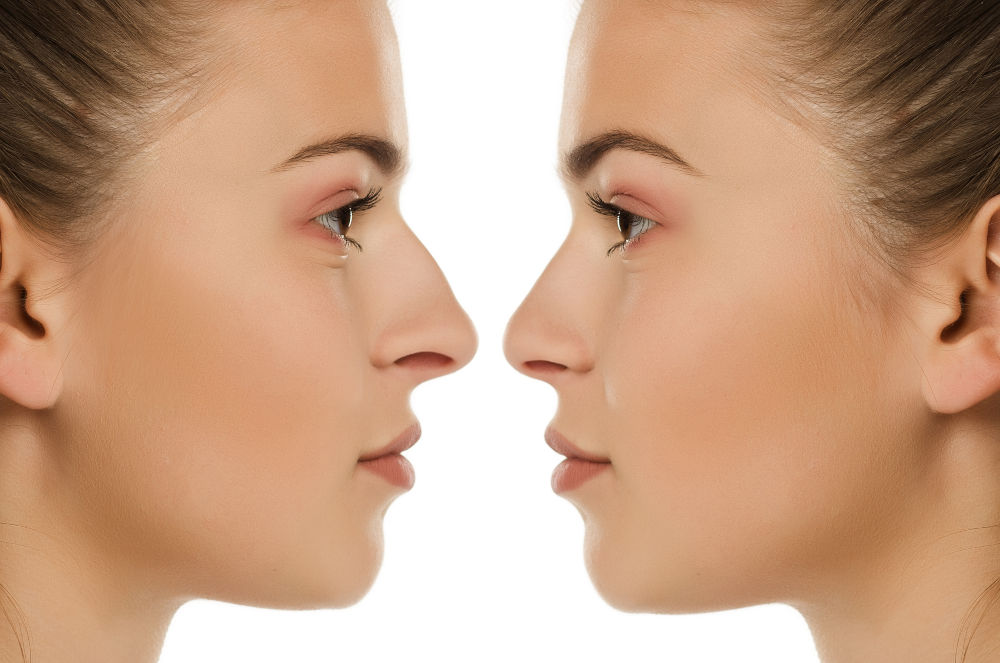 Open vs Closed Rhinoplasty: Guide for Toronto Patients
