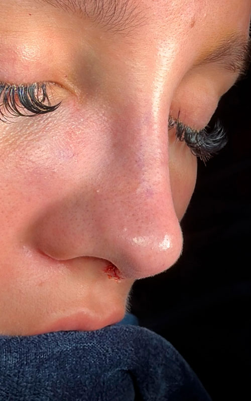 Immediate on-the-table rhinoplasty result showing a smoother bridge and a refined, gently lifted nasal tip.