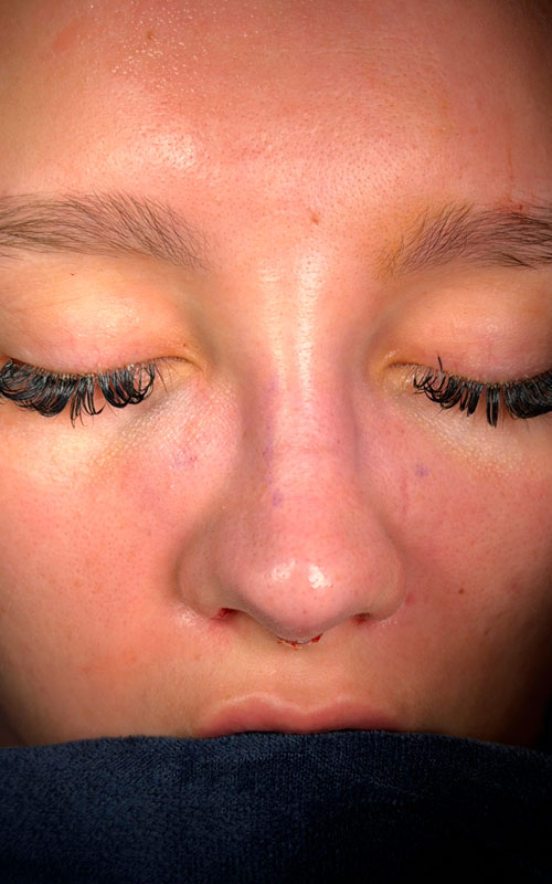 Immediate on-the-table rhinoplasty base view showing improved tip definition and preserved natural nostril symmetry.