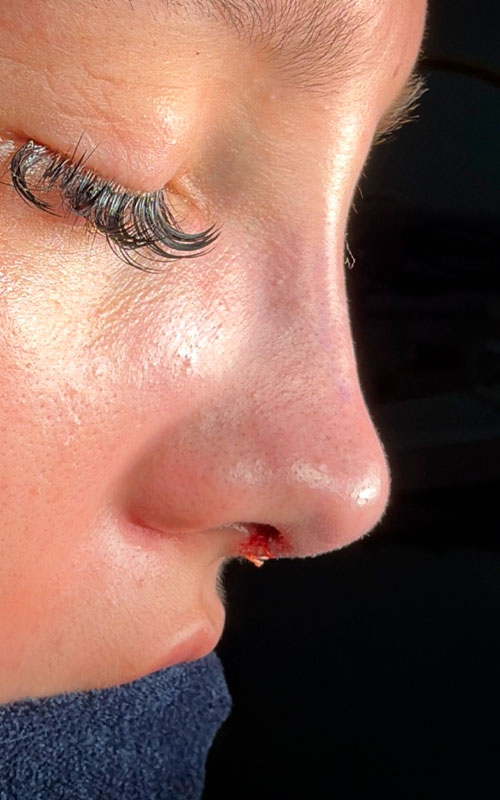 Immediate rhinoplasty result with a softened bridge contour and a subtly elevated, refined nasal tip.