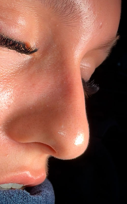 Before rhinoplasty showing a prominent dorsal hump and a heavier, slightly drooping nasal tip.