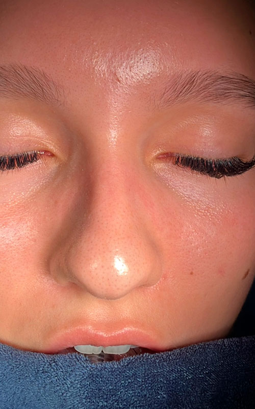 Before rhinoplasty base view showing a fuller nasal tip and natural nostril shape.