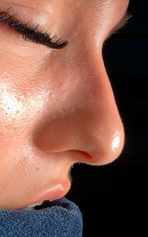 Before rhinoplasty profile showing a noticeable bridge hump and less defined nasal tip.