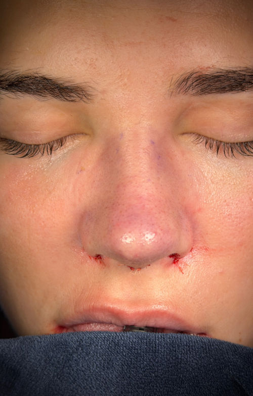 Immediate after rhinoplasty front view showing a narrower nose and increased definition through the nasal tip.