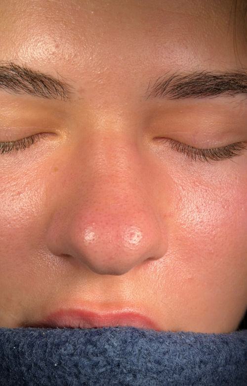 Before rhinoplasty front view showing greater width through the nose and a broad, rounded nasal tip.