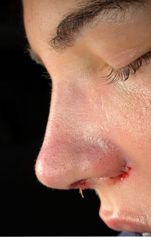 Immediate rhinoplasty result showing improved tip definition and a narrower, more refined nasal shape.