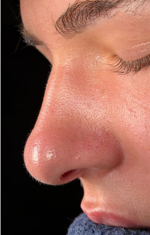 Before rhinoplasty profile showing a wider nasal tip and fuller nasal contours.