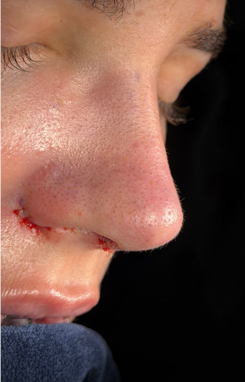 Immediate after rhinoplasty side view showing a narrower, more defined nasal tip and refined profile.