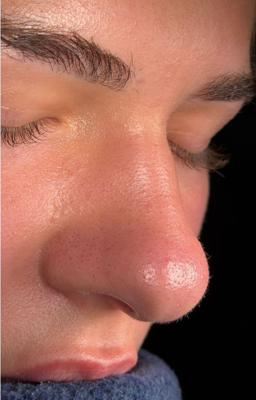 Before rhinoplasty side view showing a broad nasal tip with less definition.